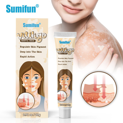 Vitiligo Cream for White Spots On Skin