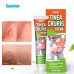 Tinea Cruris Jock Itch Cream