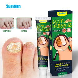 Nail Fungus Cream 30G